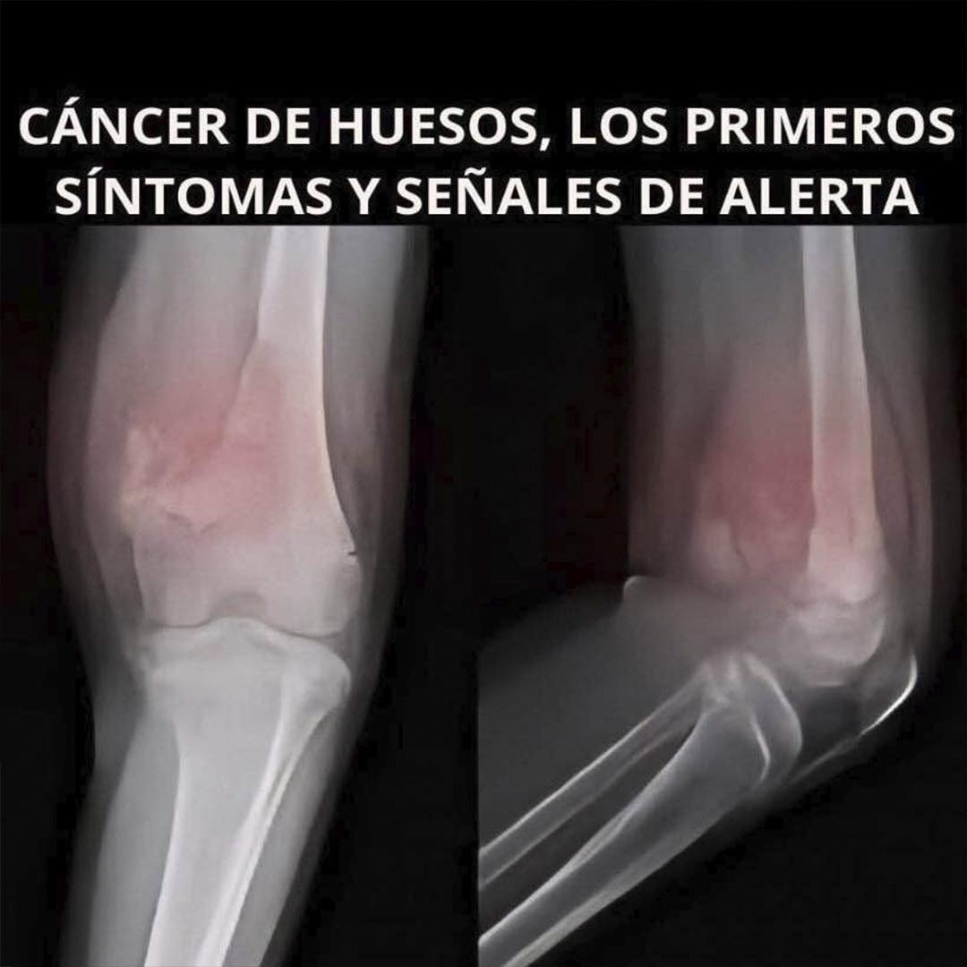 Es una enfermedad poco común pero que puede se00 … Ver más