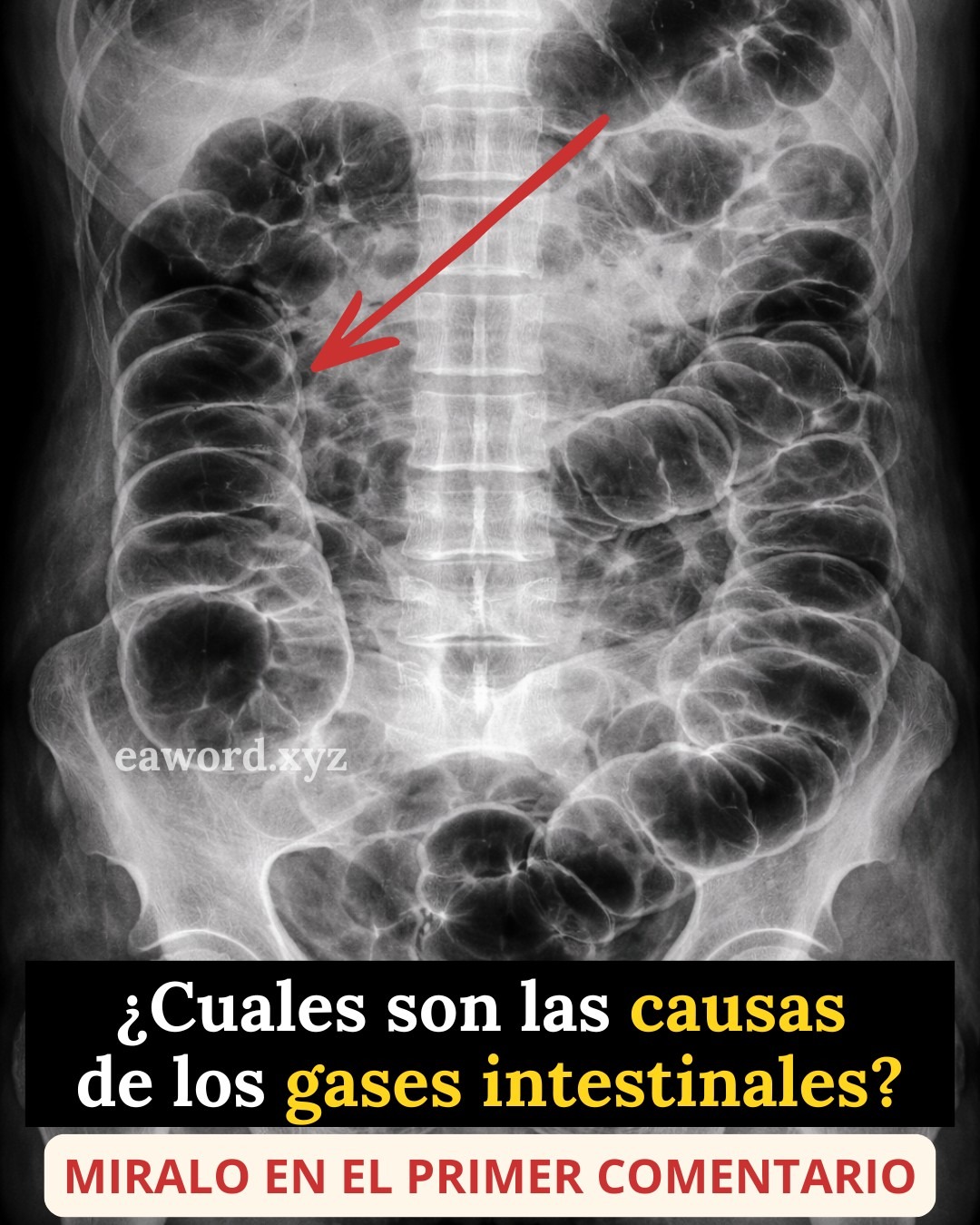 Tienes muchos gases y nadie te lo explica bien… Ver más