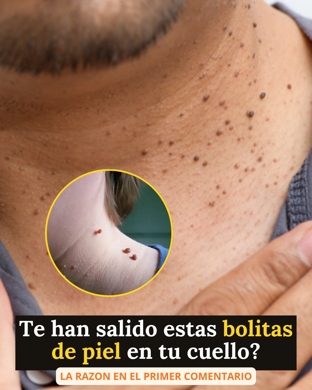 Si te has notado estas pequeñas bolitas de piel en tu cuello o axilas es que… Ver más