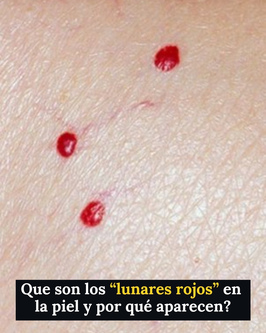 ¿Por qué te pican los mosquitos solo a ti ? la razón te va a sorprender… Ver más