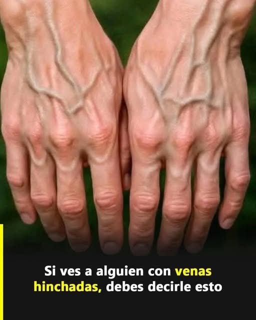Por Qué Algunas Personas Tienen las Venas de las Man..Ver más