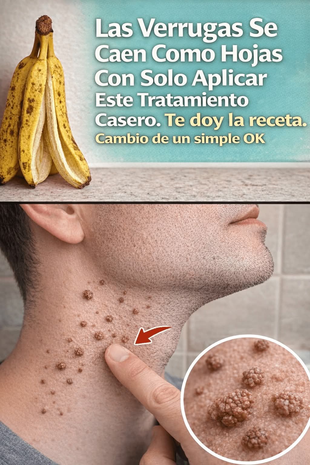 Las Verrugas Se Caen Como Hojas Con Solo Aplicar Este trata..ver mas