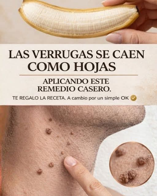 Con este remedio casero, las verrugas se caerán como hoja..ver mas