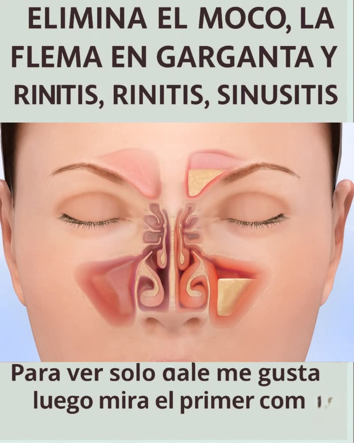 Elimina el moco, la flema en la garganta y nariz, rinitis con remedio caseros efectivos..ver mas