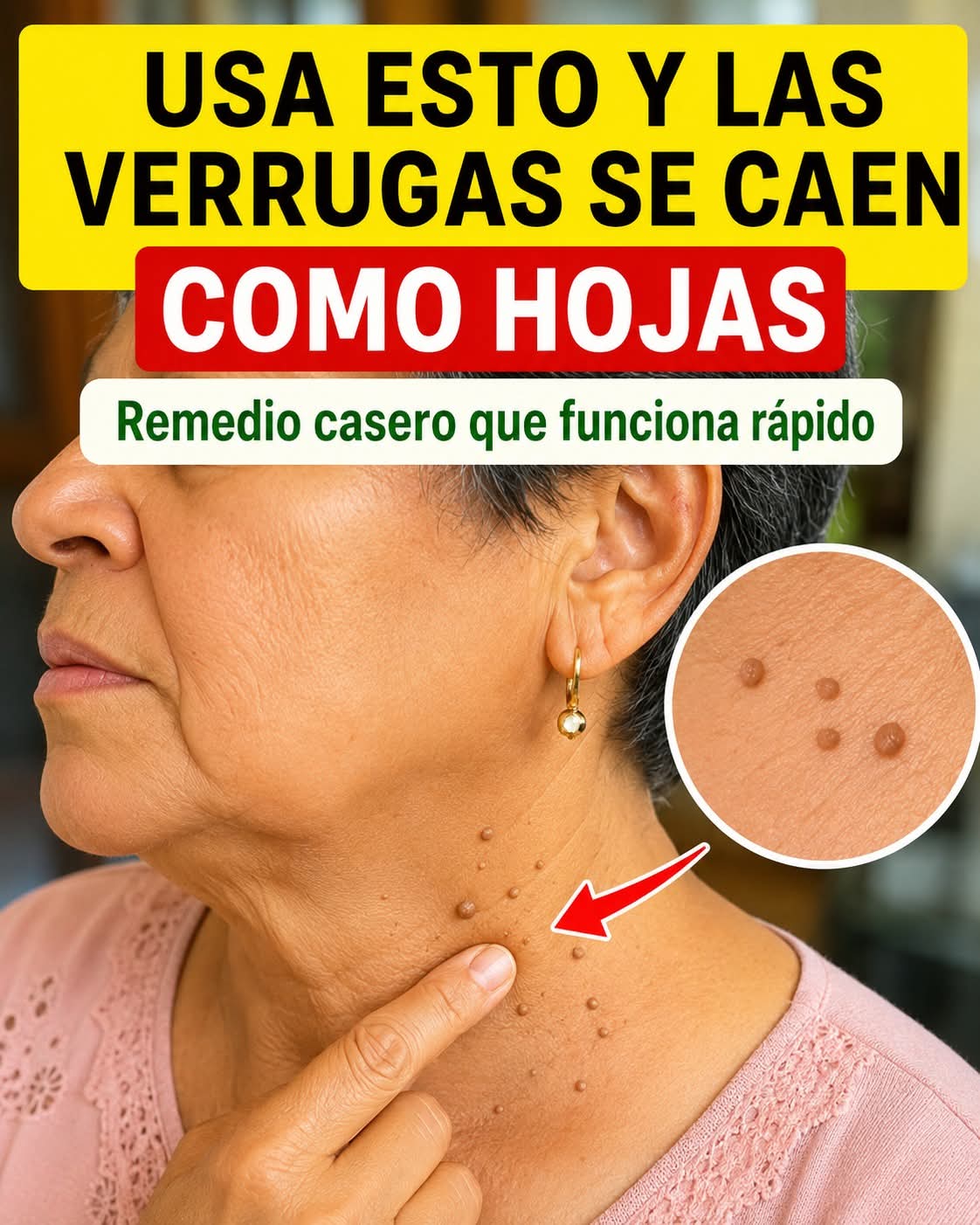 ✨ Las verrugas caerán solas con este remedio natur..ver mas